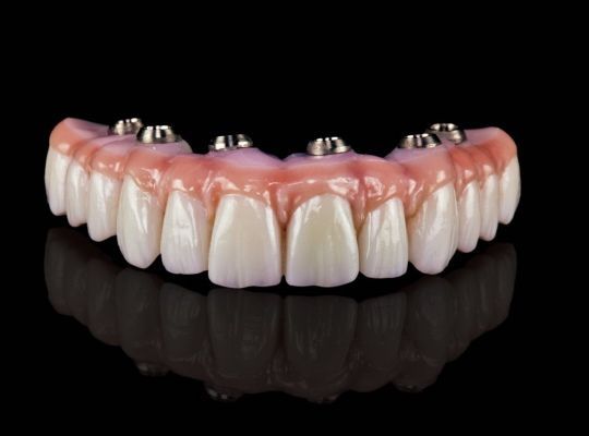 All-on-4 Konstruktion für implantatgetragene Vollversorgung