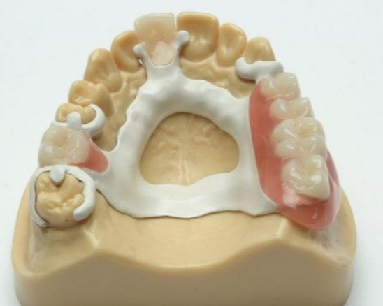 Metallfreie Klammerprothese aus PEEK – stabil, funktionell und langlebig