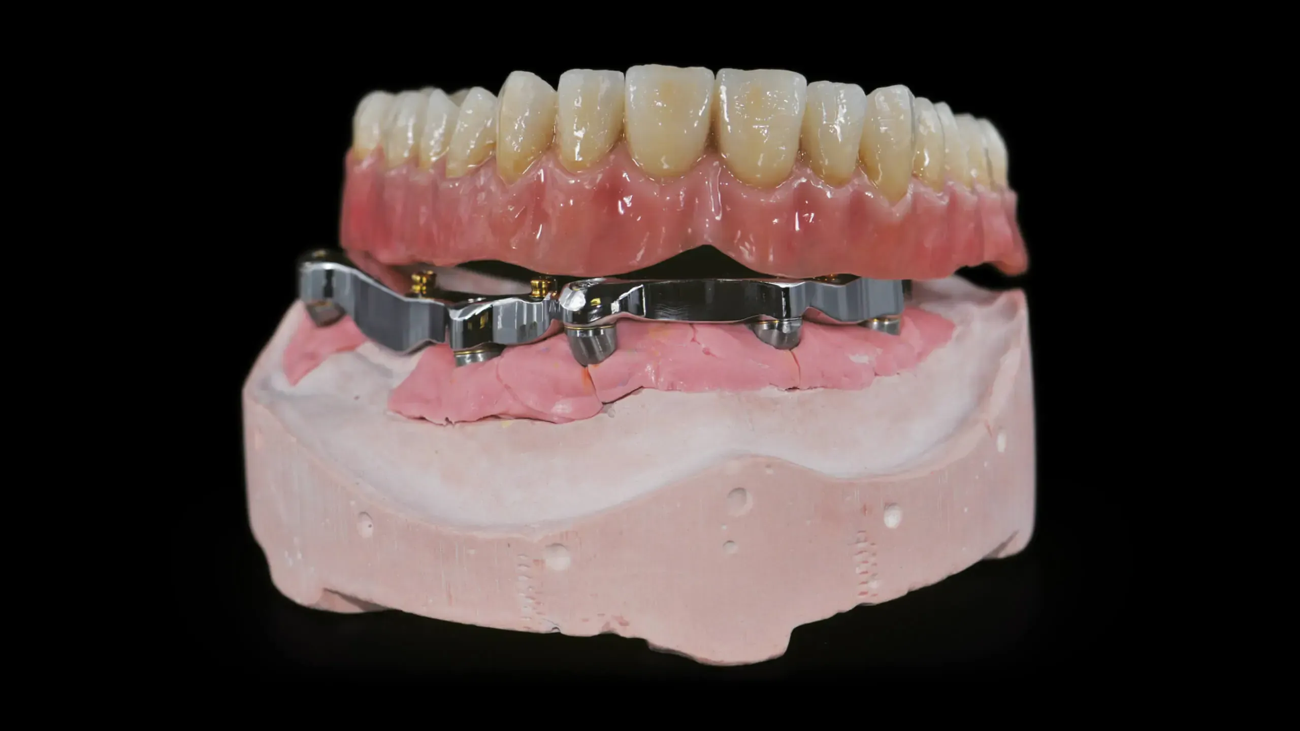 Präzise gefertigte implantatgetragene Stegversorgung aus dem Dentallabor DAH Dental