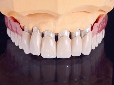 Teleskopkronen aus dem Meisterlabor DAH Dental – Primär- und Sekundärteleskope auf Modell